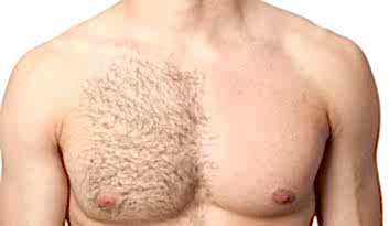 Лазерная эпиляция для мужчин 6