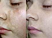 удаление пигментации на лице лазером